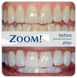 teeth whitening yonkers ny dentist innabi dental care