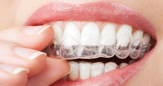 Invisalign